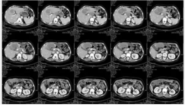 晚期胃癌治疗的思路与误区,晚期胃癌的成功治愈病例