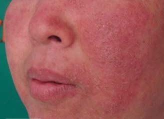 激素性皮炎修复期为什么脸总痒,激素性皮炎反复起红疹怎么办