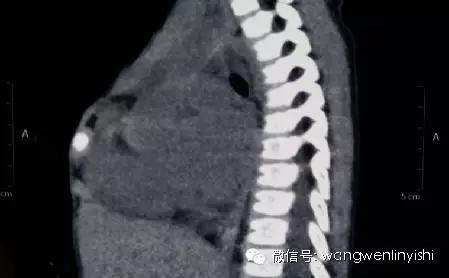 胸骨裂合并先心病的手术治疗