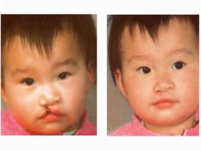 新生儿兔唇是什么原因造成的,生娃防坑指南