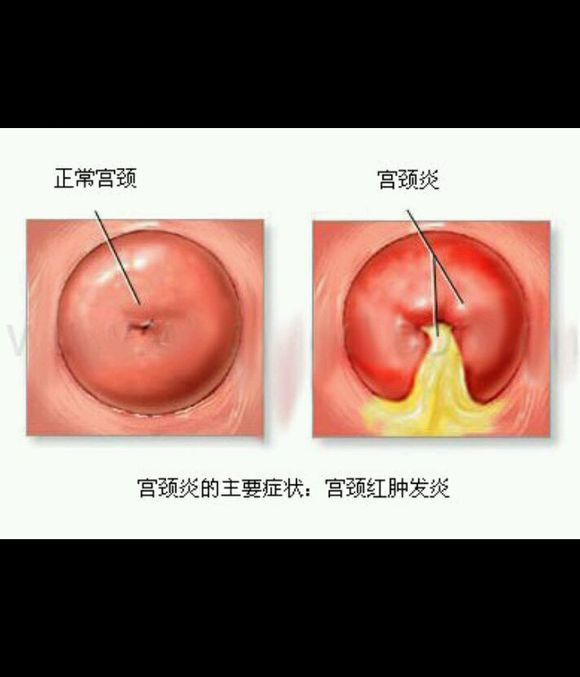 女性常见的妇科炎症有哪些,女性妇科炎症反复跟男人有关系吗