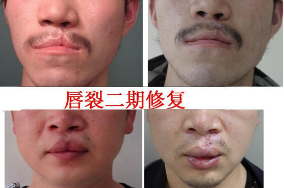 新生儿轻微兔唇是怎么造成的,生娃防坑指南