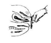 取环详细手术记录,取环术手术步骤