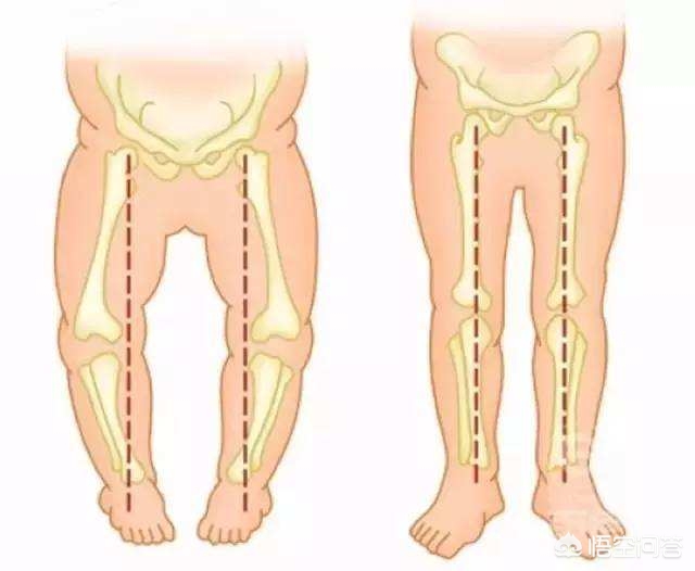 宝宝哪种现象是罗圈腿,青少年罗圈腿的矫正方法