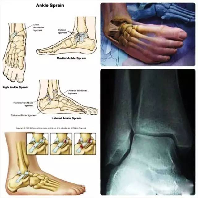 崴脚怎么治才能好得快,崴脚怎么根治