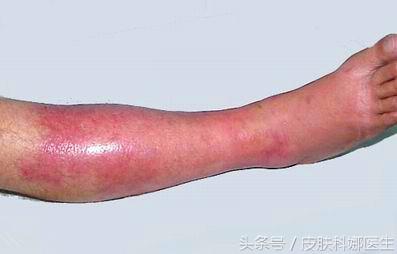 为什么一上火就有脚气,脚气到底是血热还是湿热下注