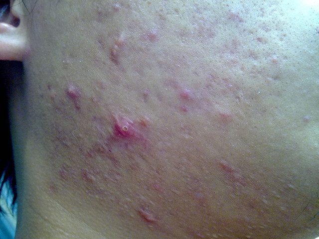 粉刺汤中药,小柴胡汤治粉刺