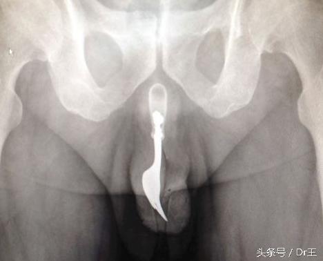 尿道插异物导致发炎,尿道长期插尿管