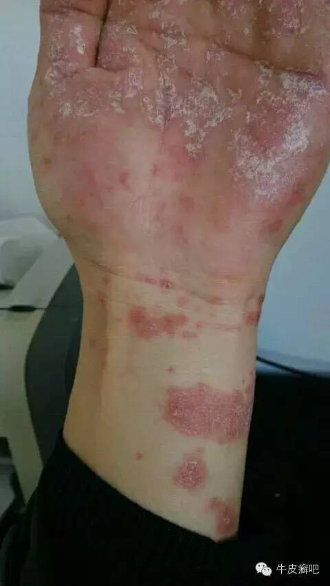 医院专家教你治疗牛皮癣,专家专治牛皮癣方法