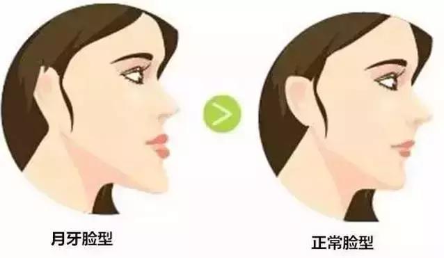 常见排齐牙齿的四大方法,牙齿拥挤重叠矫正过程