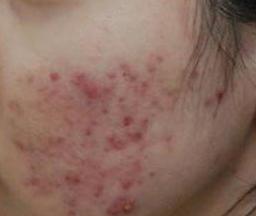 关于痘痘肌你知道多少,痘痘肌需要了解的知识