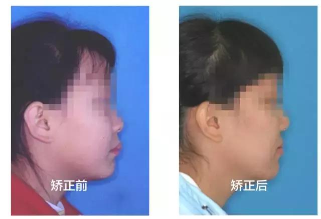 牙齿矫正是拔牙多好还是少好,为什么牙齿矫正一般都要拔牙