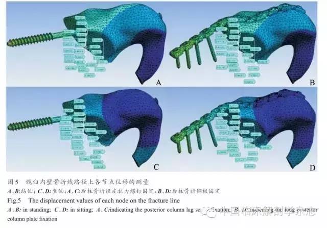 长骨骨折石膏固定术,长骨骨折夹板固定