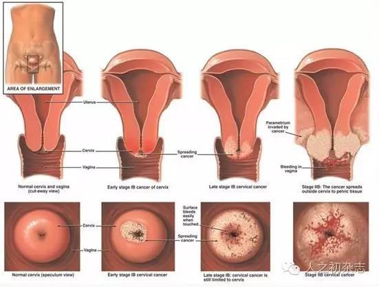 宫颈癌疫苗接种完后多久可以怀孕,宫颈癌疫苗价格表及注意事项