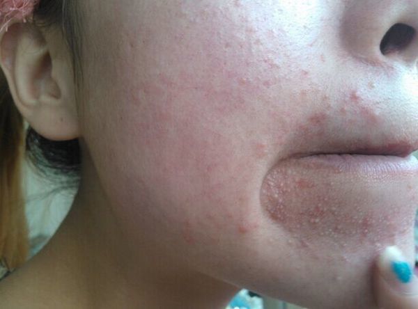 你的痘痘有救了吗,你的痘痘为什么那么难治