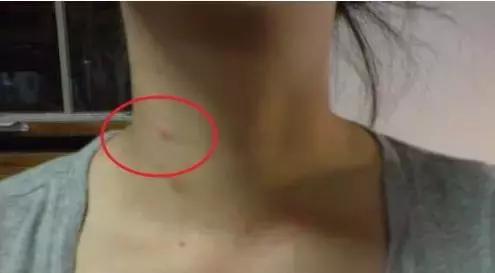 脖子长火痘是什么原因,后背脖子长痘什么原因