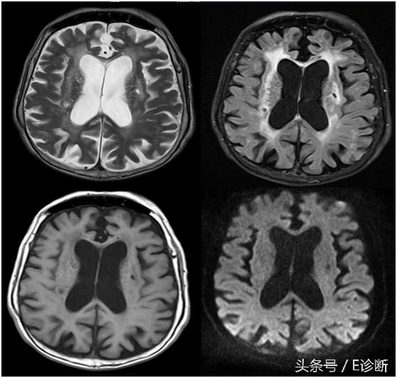 E诊断：脑梗塞影像图解