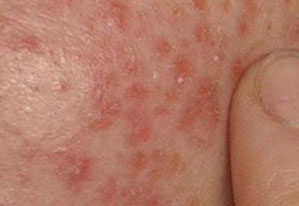 湿疹是不是春天高发,湿疹经常做这些事好得快