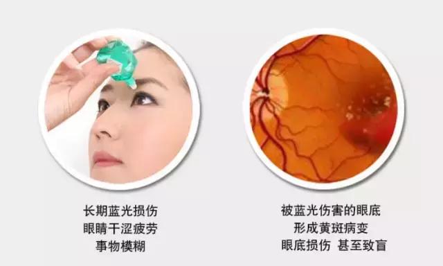 1.74防蓝光非球面镜片是什么意思,关于防蓝光