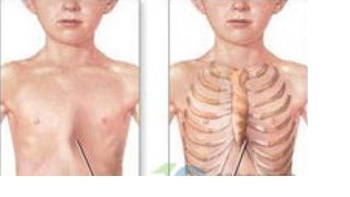 鸡胸病吃钙片能改善吗,鸡胸前期可以怎么干预