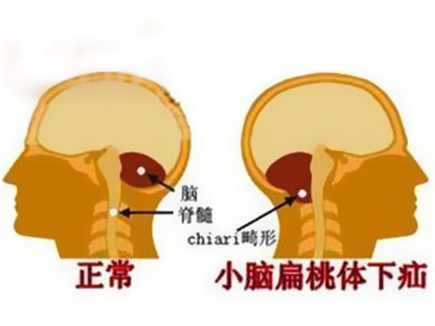 患了chiari畸形要注意什么,chiari畸形1型发病率高吗