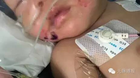 心痛！江阴3个月大男婴嘴部严重烫伤、腿部有牙印、肋骨骨折！这是一个怎样的家啊
