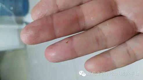 火针灸能治跖疣吗,中医火针治疗丝状疣