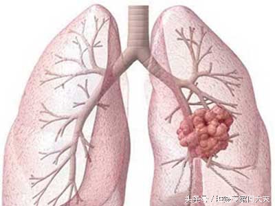 肺微浸润性腺癌能做消融手术吗,肺射频消融手术真实经历