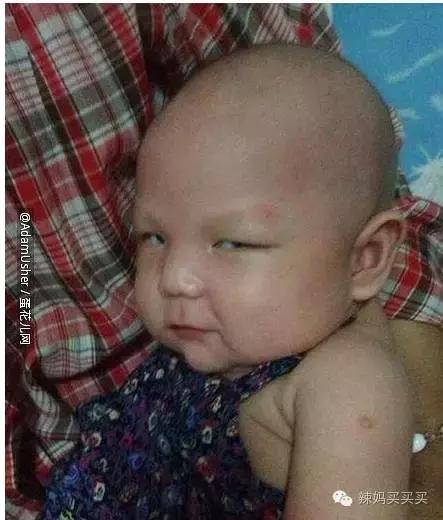 孩子长湿疹怎么办比较好,孩子长湿疹是怎么治疗