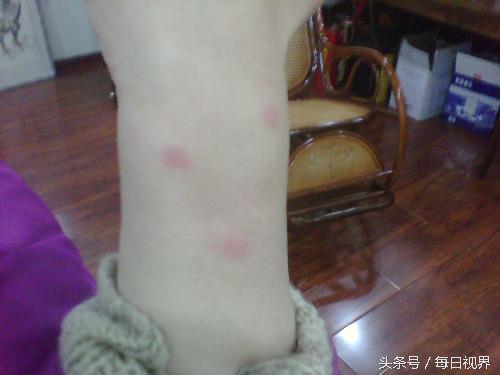 春季眼睛过敏发痒怎么办,春季皮肤过敏是什么原因