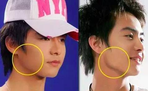 瘦脸针不适合什么病人,中年人适合打瘦脸针吗