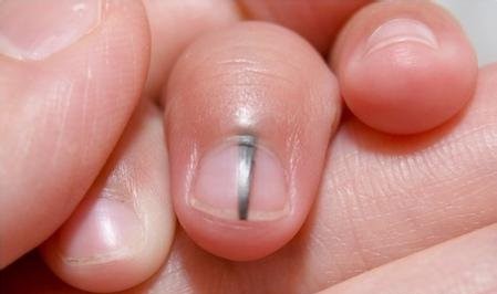 孙红雷谈黑痣长在哪里,孙红雷演的黑痣病变