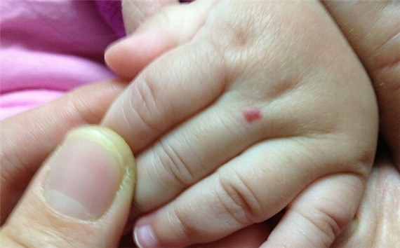 如何正确认识血管瘤,新生儿血管瘤怎么预防