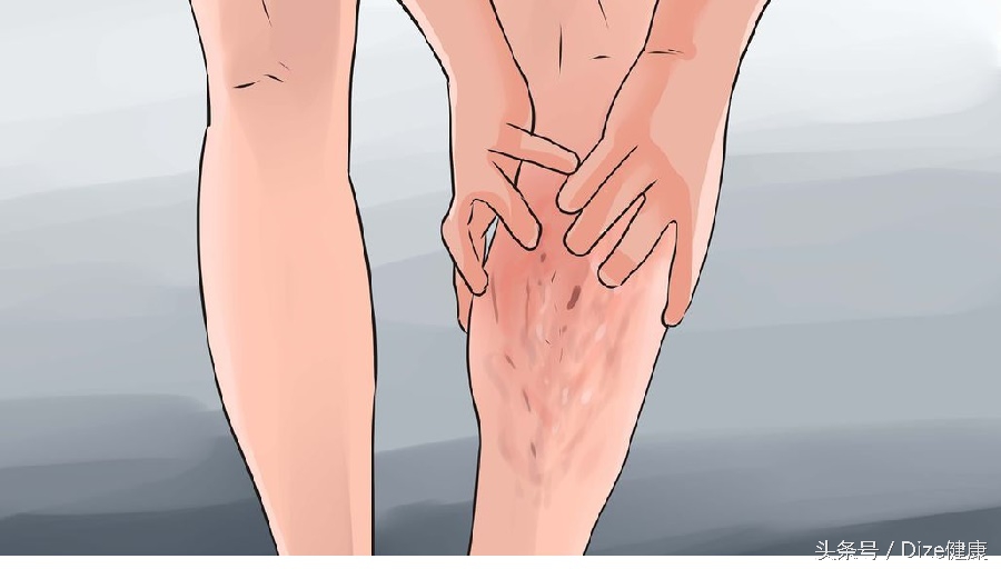 坐得久了小腿肿怎么办,静脉曲张引起的小腿肿怎么消除