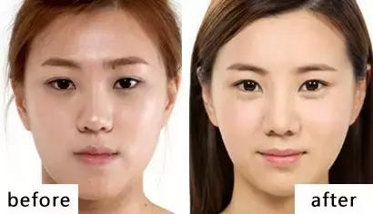 眼袋和卧蚕和泪沟的区别,你能不能搞清楚自己需要的是什么