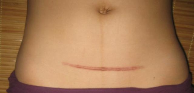 揭秘顺产有多痛,顺产的秘密后续