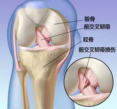 膝盖前交叉韧带损伤一般多久恢复,谈前交叉韧带