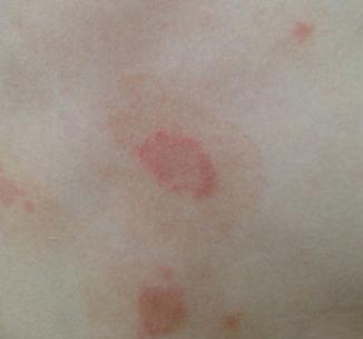 花斑癣和花斑癣一样吗,花斑癣和花斑癣的区别