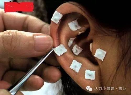 睡眠不好如何贴三伏贴,睡眠不好贴祛湿贴