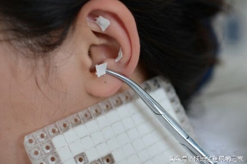 耳穴压豆治疗烟瘾,耳穴戒烟穴位