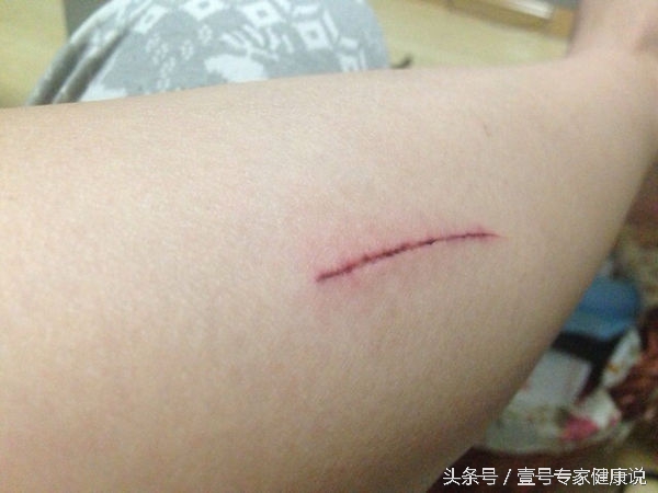 烫伤扭伤急救方法和注意事项,刺伤流血怎么急救