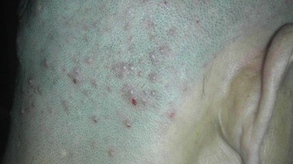 十三岁男孩头上长痘痘什么原因,头上和背上长痘痘是什么原因