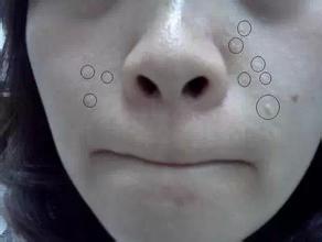 眼角长的脂肪粒怎么可以避免,眼角长了一个脂肪粒怎么办