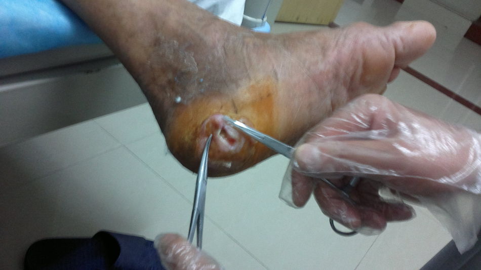 糖尿病的护理措施是,糖尿病延续性护理方案