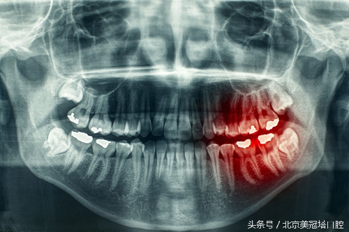冷热酸甜入口,牙齿酸痛难忍怎么治?