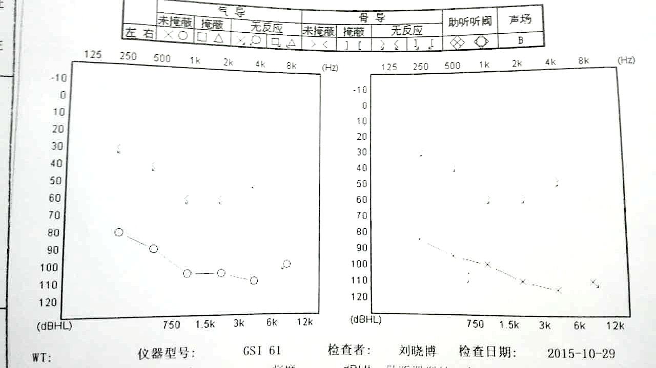 耳蜗植入另一侧需要助听器吗 (做了耳蜗敢不敢戴助听器)