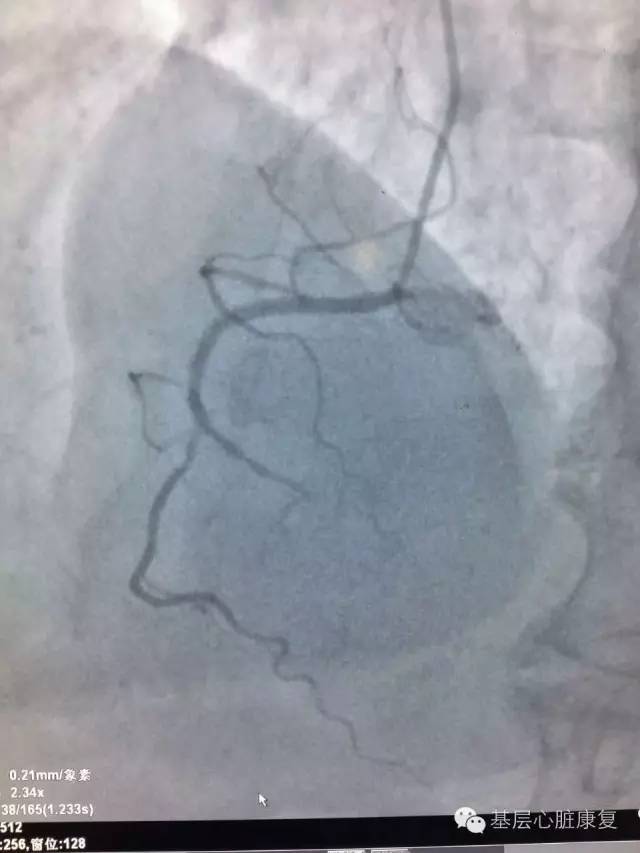 攻克冠心病,治疗冠心病的高科技