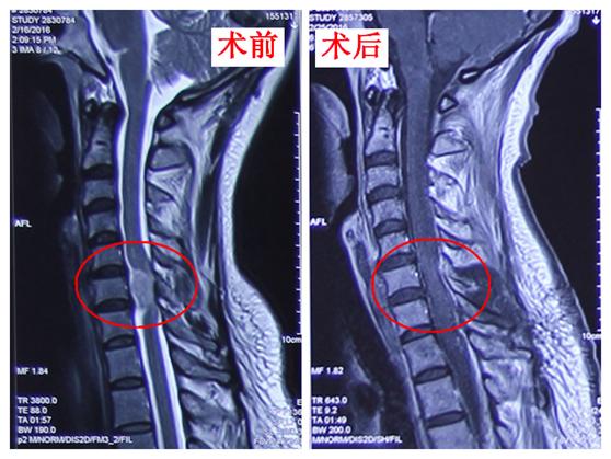 病例分享最后总结,颈静脉孔区神经鞘瘤全切复发概率