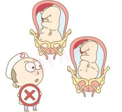 什么是头盆不称？小宝宝头盆不称能顺产吗？