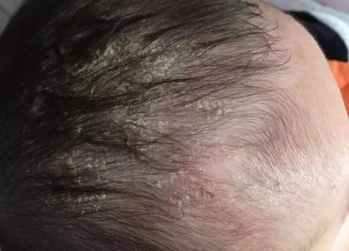 得了脂溢性皮炎会不会秃,得了脂溢性皮炎一定会秃顶吗